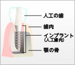入れ歯